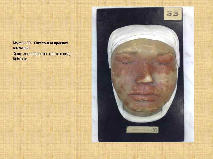  Муляж 33. Системная красная волчанка. Кожа лица красного цвета в виде бабочки. 