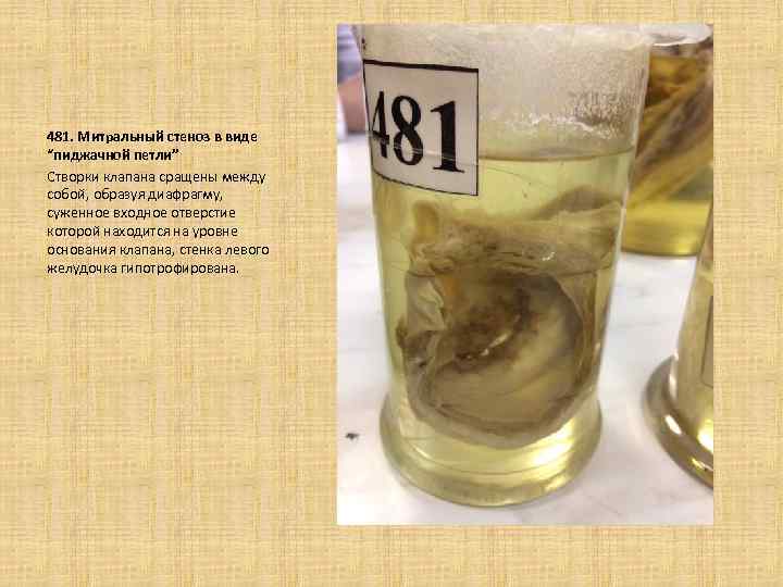 481. Митральный стеноз в виде “пиджачной петли” Створки клапана сращены между собой, образуя диафрагму,