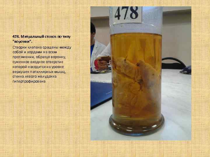 478. Митральный стеноз по типу "воронки". Створки клапана сращены между собой и хордами на