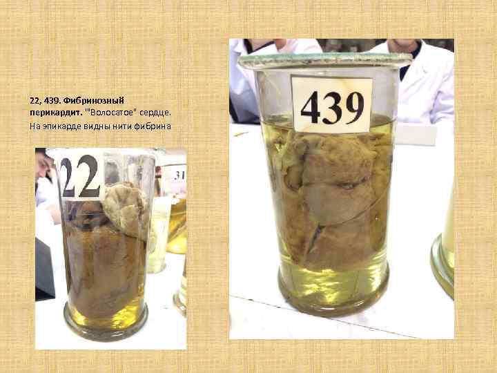  22, 439. Фибринозный перикардит. '"Волосатое" сердце. На эпикарде видны нити фибрина 