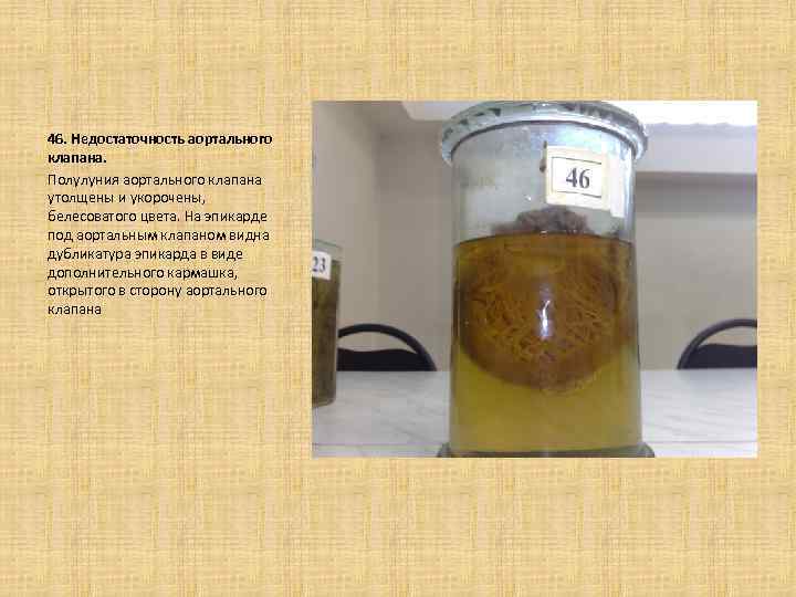 46. Недостаточность аортального клапана. Полулуния аортального клапана утолщены и укорочены, белесоватого цвета. На эпикарде