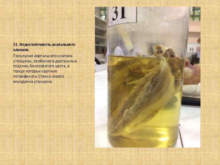 31. Недостаточность аортального клапана. Полулуния аортального клапана утолщены, особенно в дистальных отделах, белесоватого