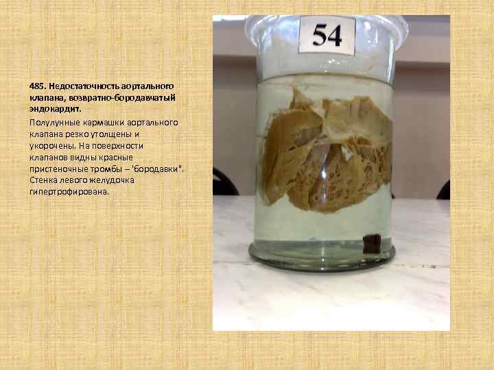 485. Недостаточность аортального клапана, возвратно-бородавчатый эндокардит. Полулунные кармашки аортального клапана резко утолщены и укорочены.