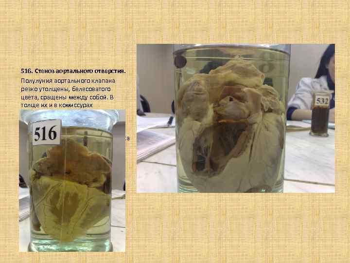  516. Стеноз аортального отверстия. Полулуния аортального клапана резко утолщены, белесоватого цвета, сращены между