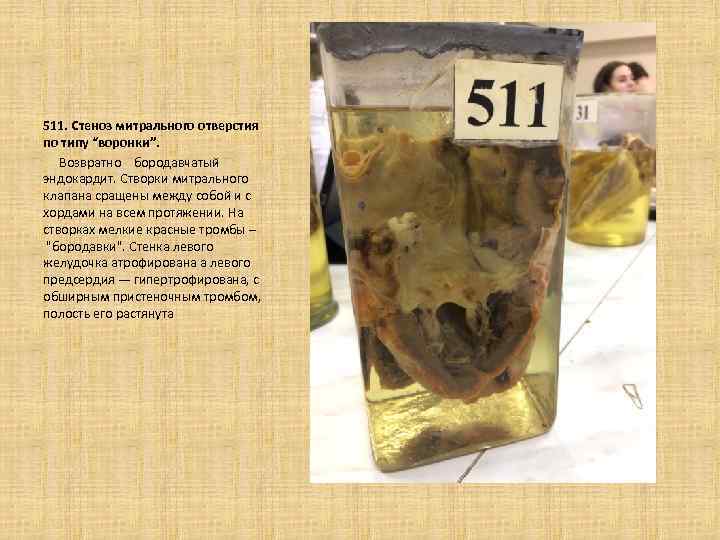 511. Стеноз митрального отверстия по типу “воронки”. Возвратно бородавчатый эндокардит. Створки митрального клапана сращены