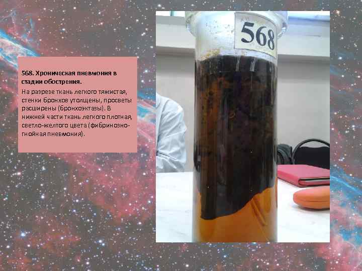  568. Хроническая пневмония в стадии обострения. На разрезе ткань легкого тяжистая, стенки бронхов