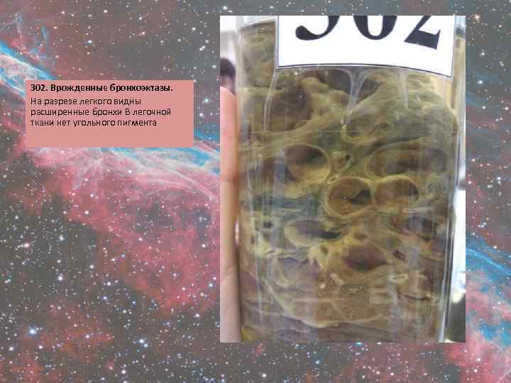 302. Врожденные бронхоэктазы. На разрезе легкого видны расширенные бронхи В легочной ткани нет угольного