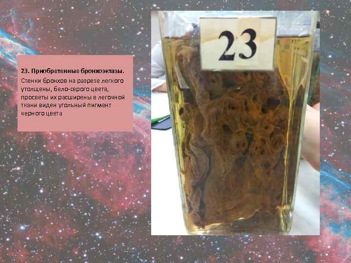  23. Приобретенные бронхоэктазы. Стенки бронхов на разрезе легкого утолщены, бело-серого цвета, просветы их