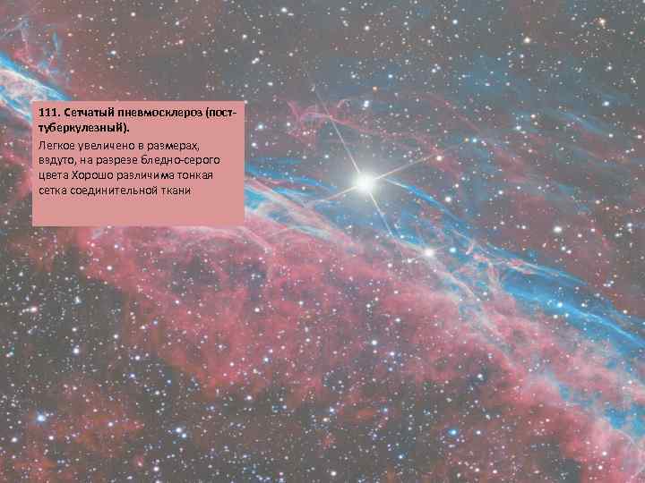 111. Сетчатый пневмосклероз (посттуберкулезный). Легкое увеличено в размерах, вздуто, на разрезе бледно-серого цвета Хорошо