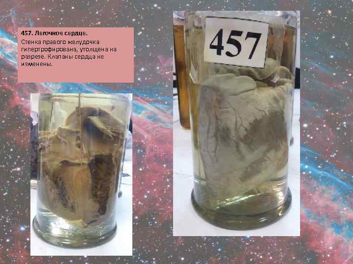 457. Легочное сердце. Стенка правого желудочка гипертрофирована, утолщена на разрезе. Клапаны сердца не изменены.