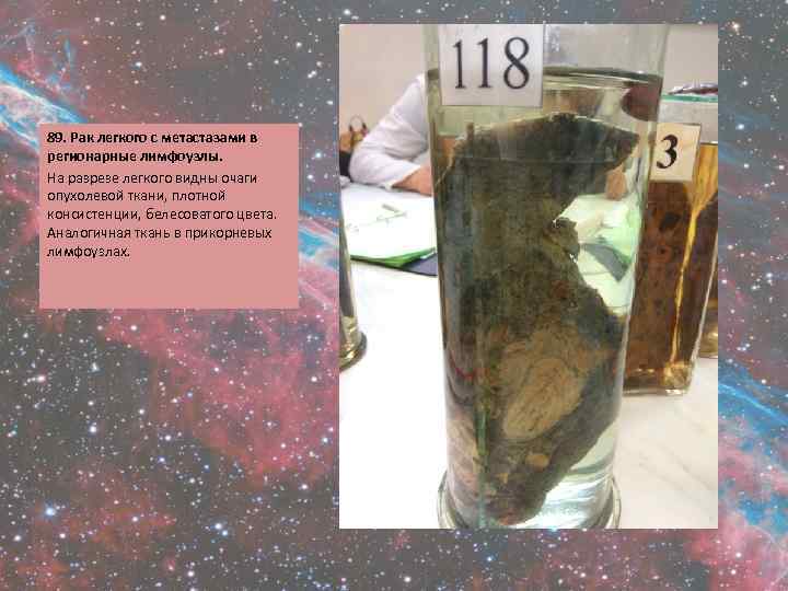89. Рак легкого с метастазами в регионарные лимфоузлы. На разрезе легкого видны очаги опухолевой