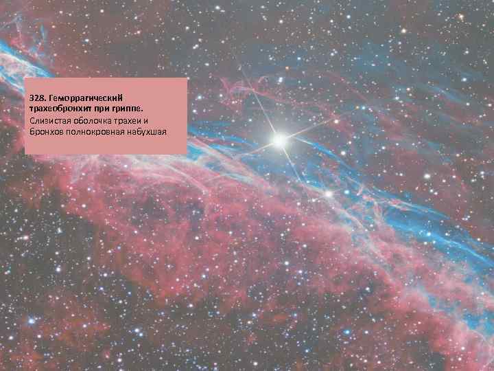  328. Геморрагический трахеобронхит при гриппе. Слизистая оболочка трахеи и бронхов полнокровная набухшая 