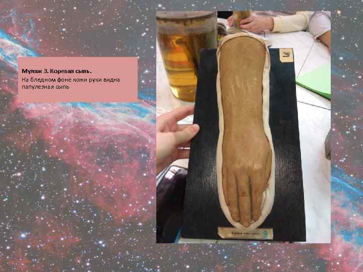  Муляж 3. Коревая сыпь. На бледном фоне кожи руки видна папулезная сыпь 