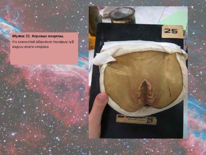 Муляж 25. Коревые некрозы. На слизистой оболочке половых губ видны очаги некроза 