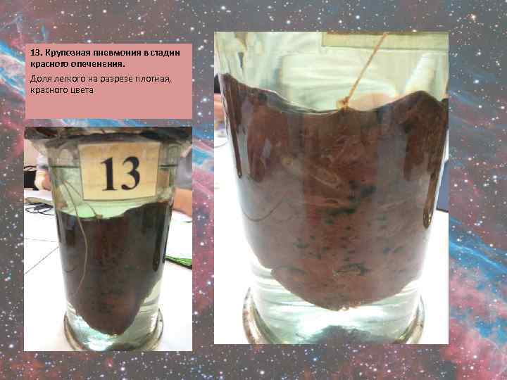 13. Крупозная пневмония в стадии красного опеченения. Доля легкого на разрезе плотная, красного цвета