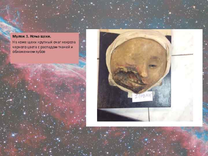 Муляж 1. Нома щеки. На коже щеки крупный очаг некроза черного цвета с распадом
