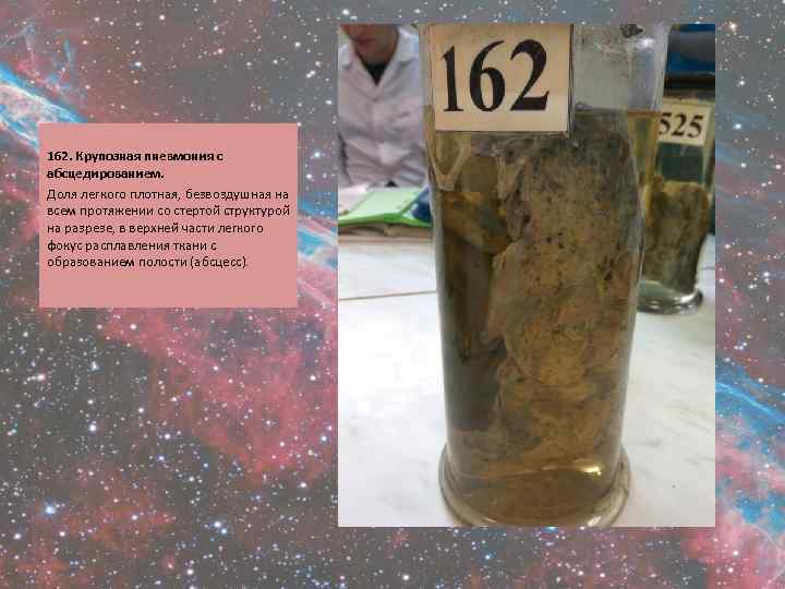  162. Крупозная пневмония с абсцедированием. Доля легкого плотная, безвоздушная на всем протяжении со