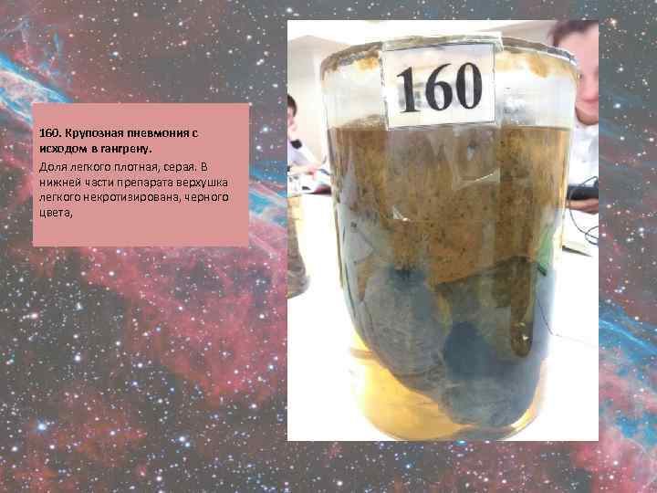  160. Крупозная пневмония с исходом в гангрену. Доля легкого плотная, серая. В нижней
