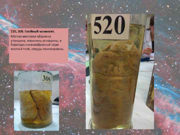 520, 309. Гнойный менингит. Мягкая мозговая оболочка утолщена, извилины уплощены, в бороздах сливкообразный серожелтый