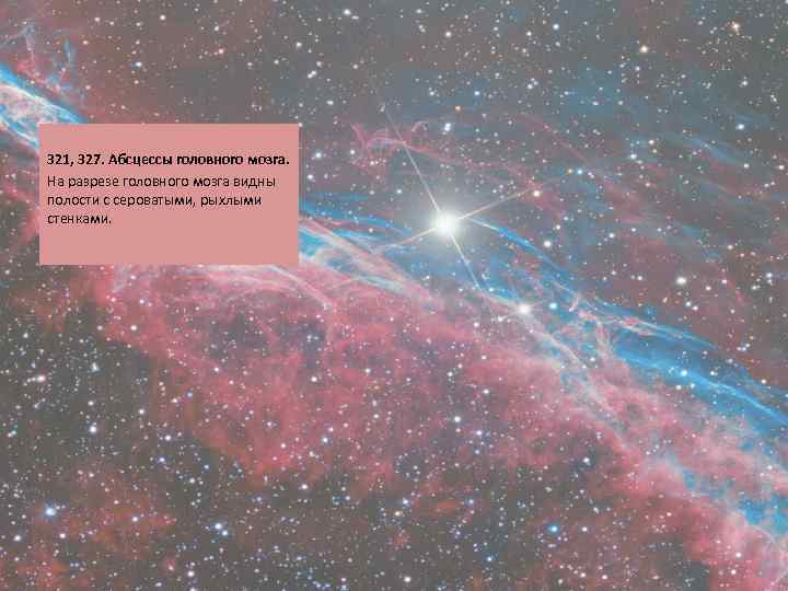  321, 327. Абсцессы головного мозга. На разрезе головного мозга видны полости с сероватыми,