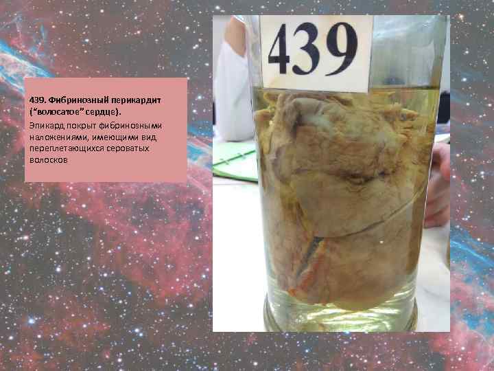  439. Фибринозный перикардит (“волосатое” сердце). Эпикард покрыт фибринозными наложениями, имеющими вид переплетающихся сероватых