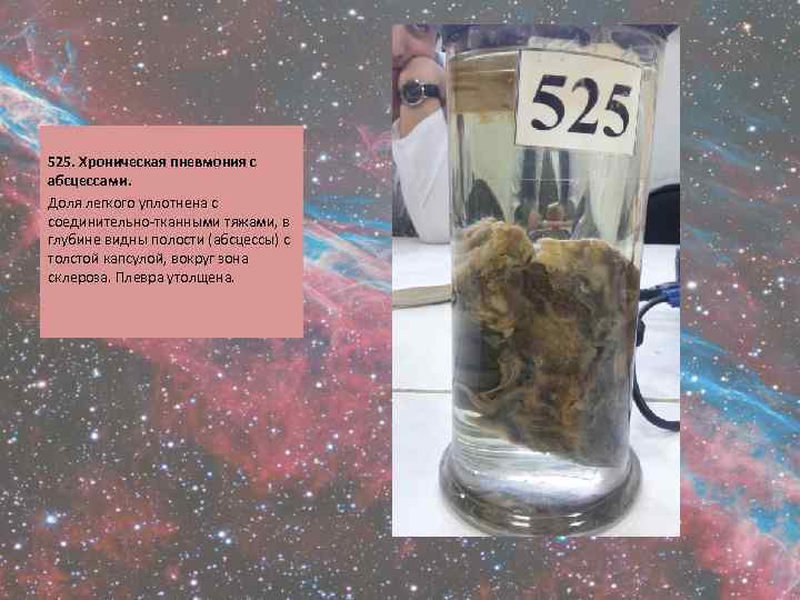  525. Хроническая пневмония с абсцессами. Доля легкого уплотнена с соединительно-тканными тяжами, в глубине