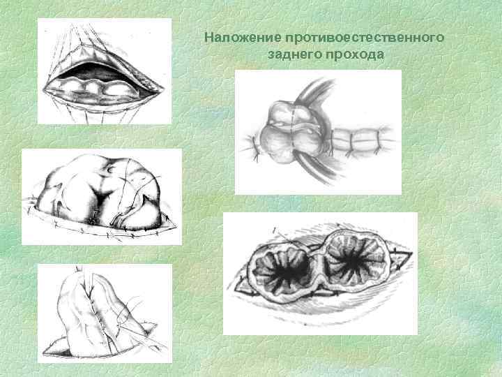 Наложение противоестественного заднего прохода 