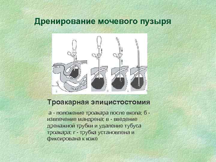 Операция мочевого. Цистостомия эпицистостомия. Троакарная цистостомия ход операции. Эпицистостома техника операции. Эпицистостомия этапы операции.