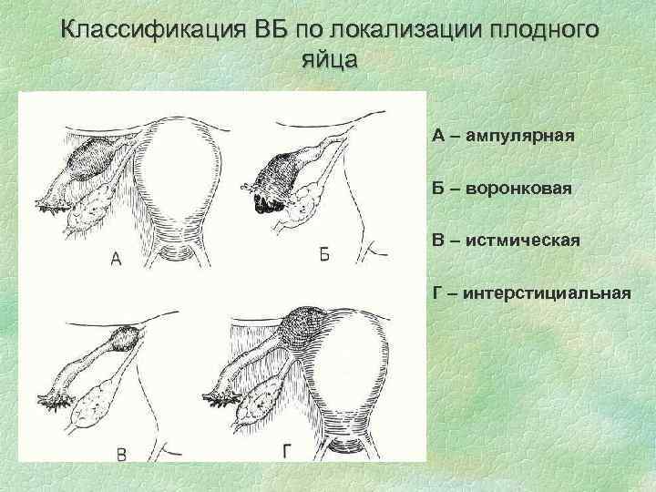 Классификация ВБ по локализации плодного яйца А – ампулярная Б – воронковая В –