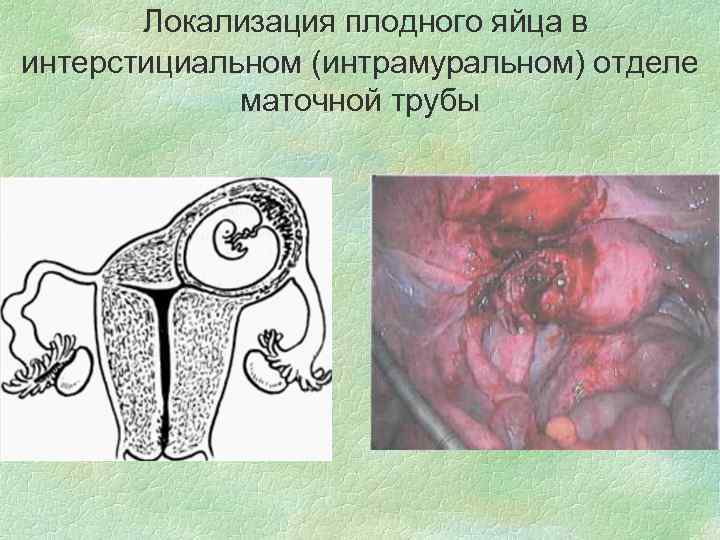 Локализация плодного яйца в интерстициальном (интрамуральном) отделе маточной трубы 