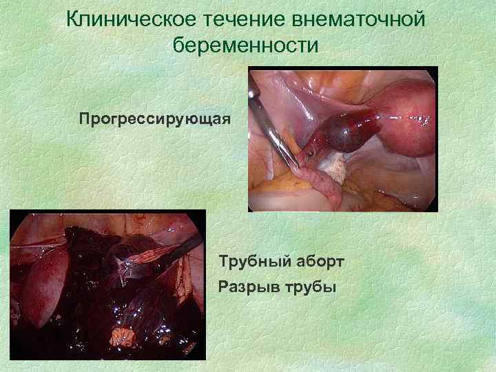 Клиническое течение внематочной беременности Прогрессирующая Трубный аборт § Разрыв трубы 