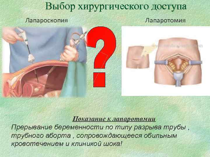 Выбор хирургического доступа Лапароскопия Лапаротомия Показание к лапаротомии Прерывание беременности по типу разрыва трубы