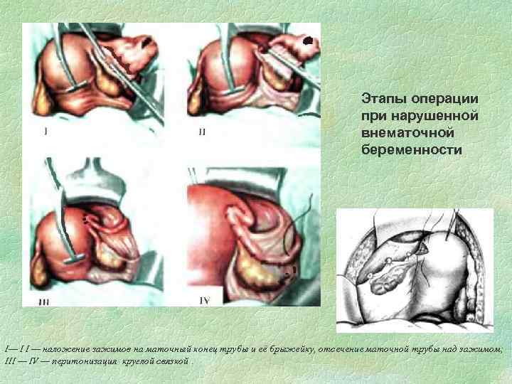 Этапы операции при нарушенной внематочной беременности I— I I — наложение зажимов на маточный