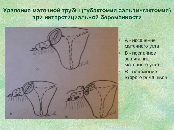 Удаление маточной трубы (тубэктомия, сальпингэктомия) при интерстициальной беременности § А - иссечение маточного угла