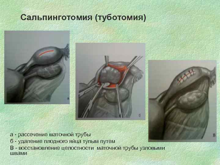 Сальпинготомия (туботомия) а - рассечение маточной трубы б - удаление плодного яйца тупым путем