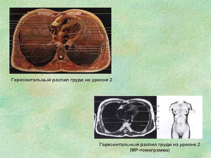 Горизонтальный распил груди на уровне 2 (МР-томограмма) 