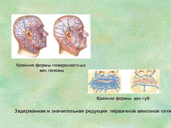 Крайние формы поверхностных вен головы Крайние формы вен губ Задержанная и значительная редукция первичной