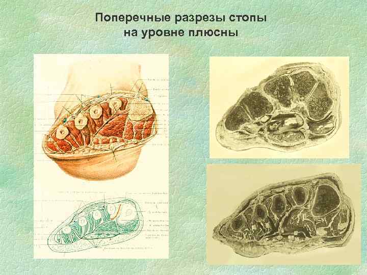 Поперечные разрезы стопы на уровне плюсны 