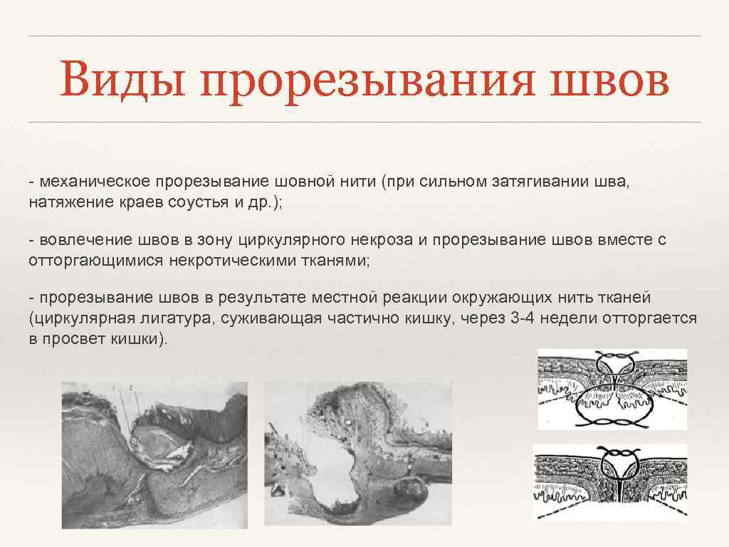 Виды прорезывания швов - механическое прорезывание шовной нити (при сильном затягивании шва, натяжение краев