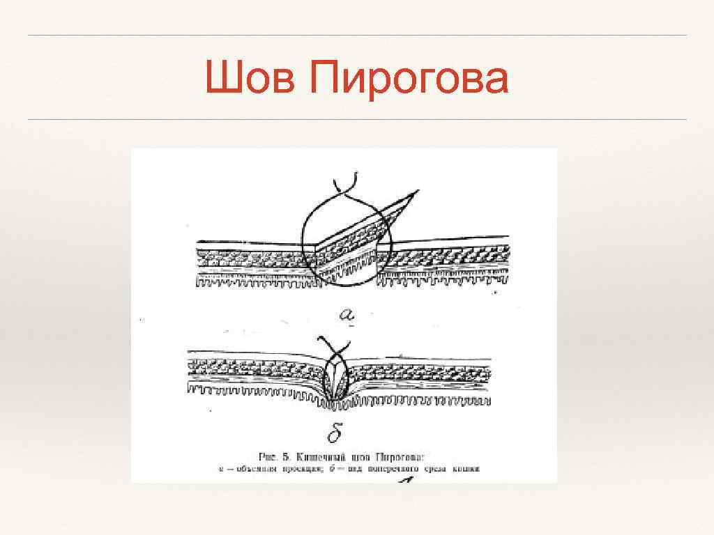 Швах это. Шов Пирогова Матешука. Кишечные швы шов Пирогова. Кишечный шов Пирогова черни. Однорядный непрерывный кишечный шов.