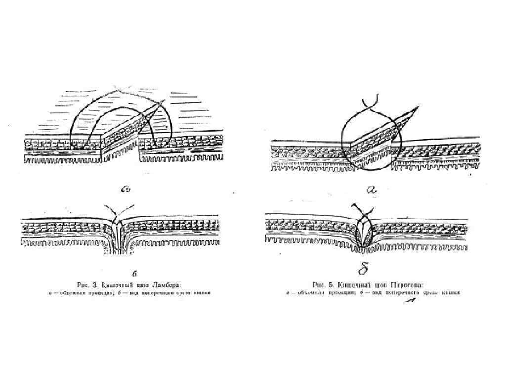 Кишечные швы. Кишечные швы топографическая анатомия. Кишечные швы (по шмидену, по Ламберту, по Плахотину -Садовскому. Шов Ламбера кишечный обоснование. Крестообразный кишечный шов.