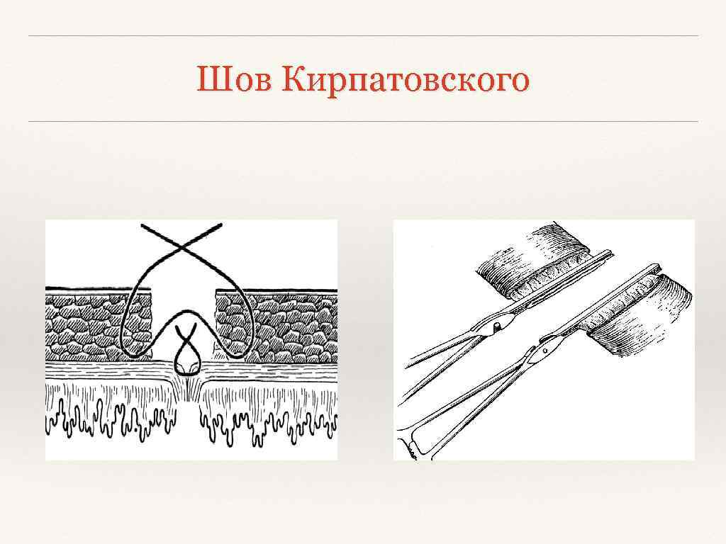 Стерильный шов