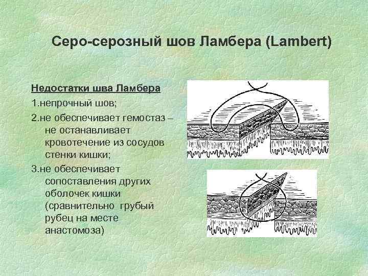 Серо-серозный шов Ламбера (Lambert) Недостатки шва Ламбера 1. непрочный шов; 2. не обеспечивает гемостаз