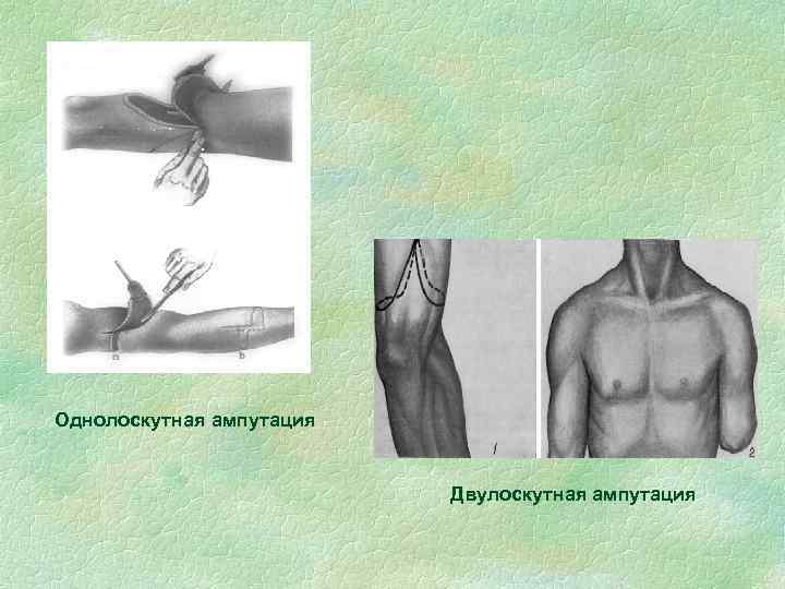 Однолоскутная ампутация Двулоскутная ампутация 