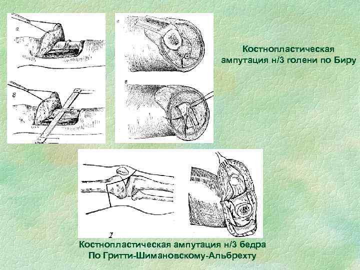 Костнопластическая ампутация н/3 голени по Биру Костнопластическая ампутация н/3 бедра По Гритти-Шимановскому-Альбрехту 