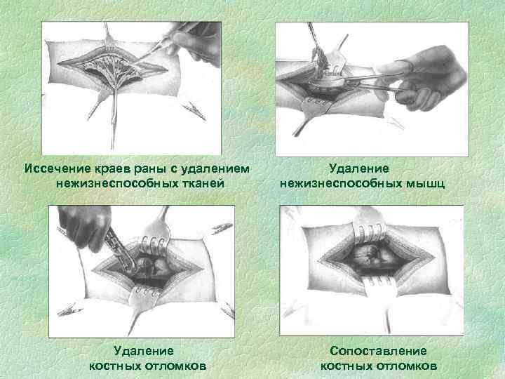 Иссечение краев раны с удалением нежизнеспособных тканей Удаление костных отломков Удаление нежизнеспособных мышц Сопоставление