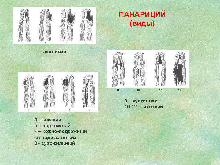 ПАНАРИЦИЙ (виды) Паронихии 9 10 11 9 – суставной 10 -12 – костный 5