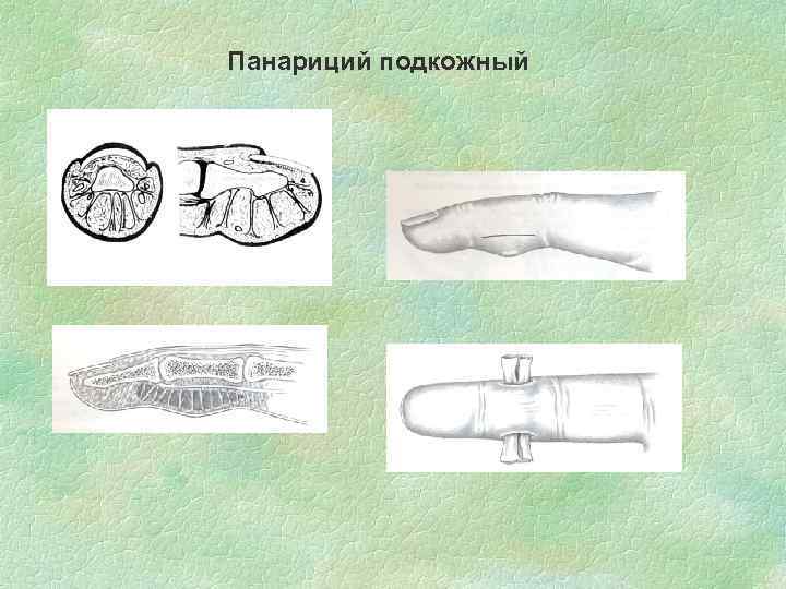 Панариций подкожный 