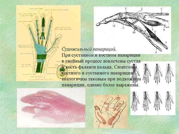 Сухожильный панариций. При суставном и костном панариции в гнойный процесс вовлечены сустав и кость