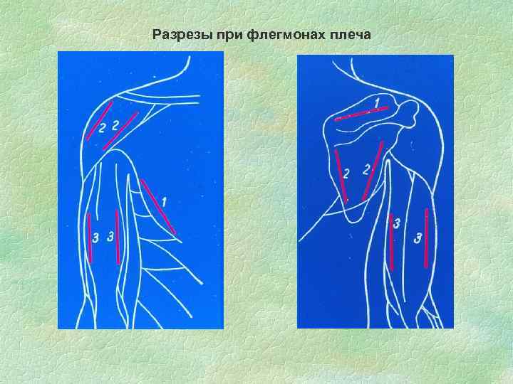 Разрезы при флегмонах плеча 